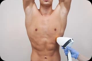 Laserová epilácia intímnej oblasti pánska Košice