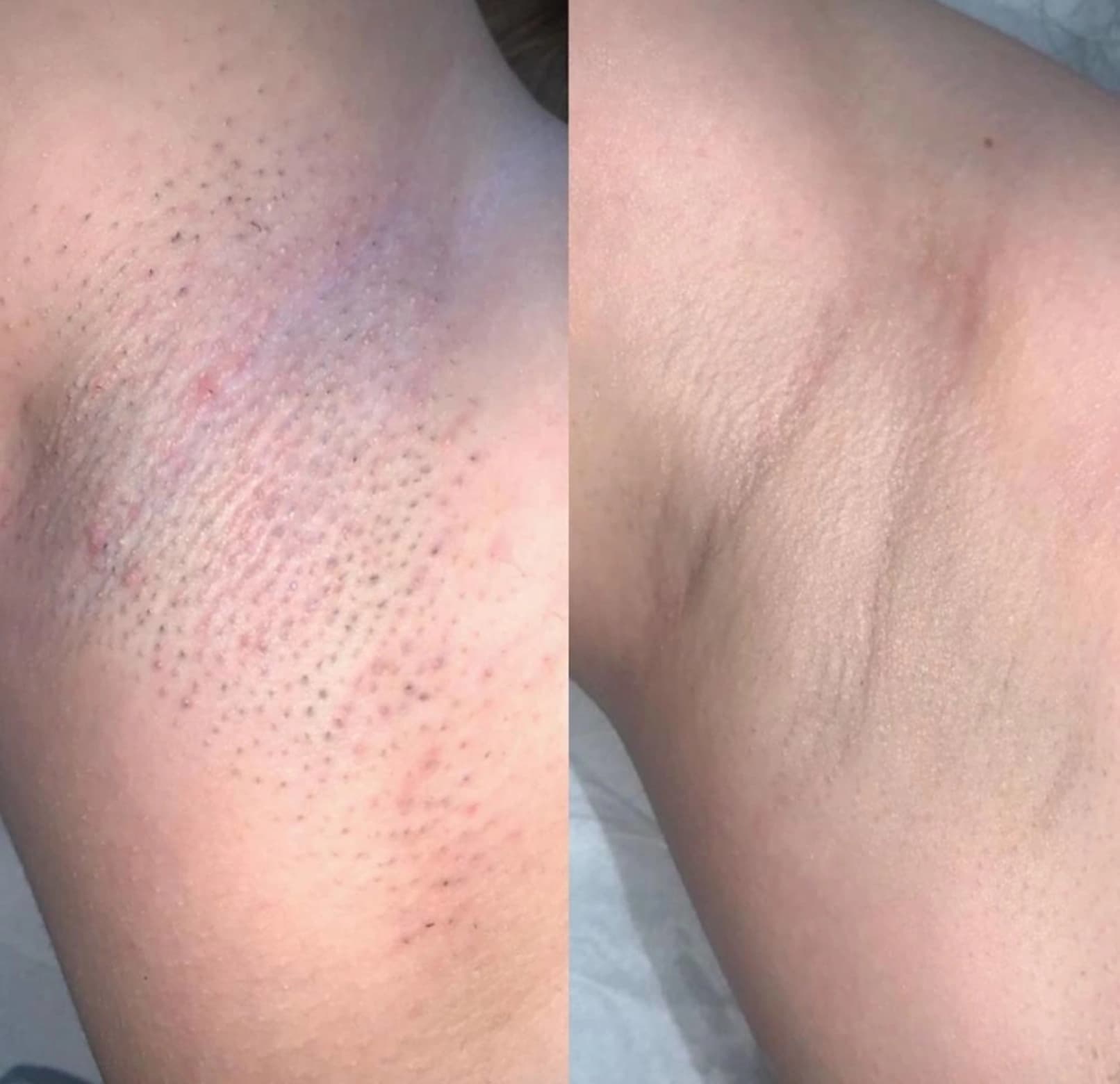 Laserová epilácia – Podpazušie, výsledok pred a po