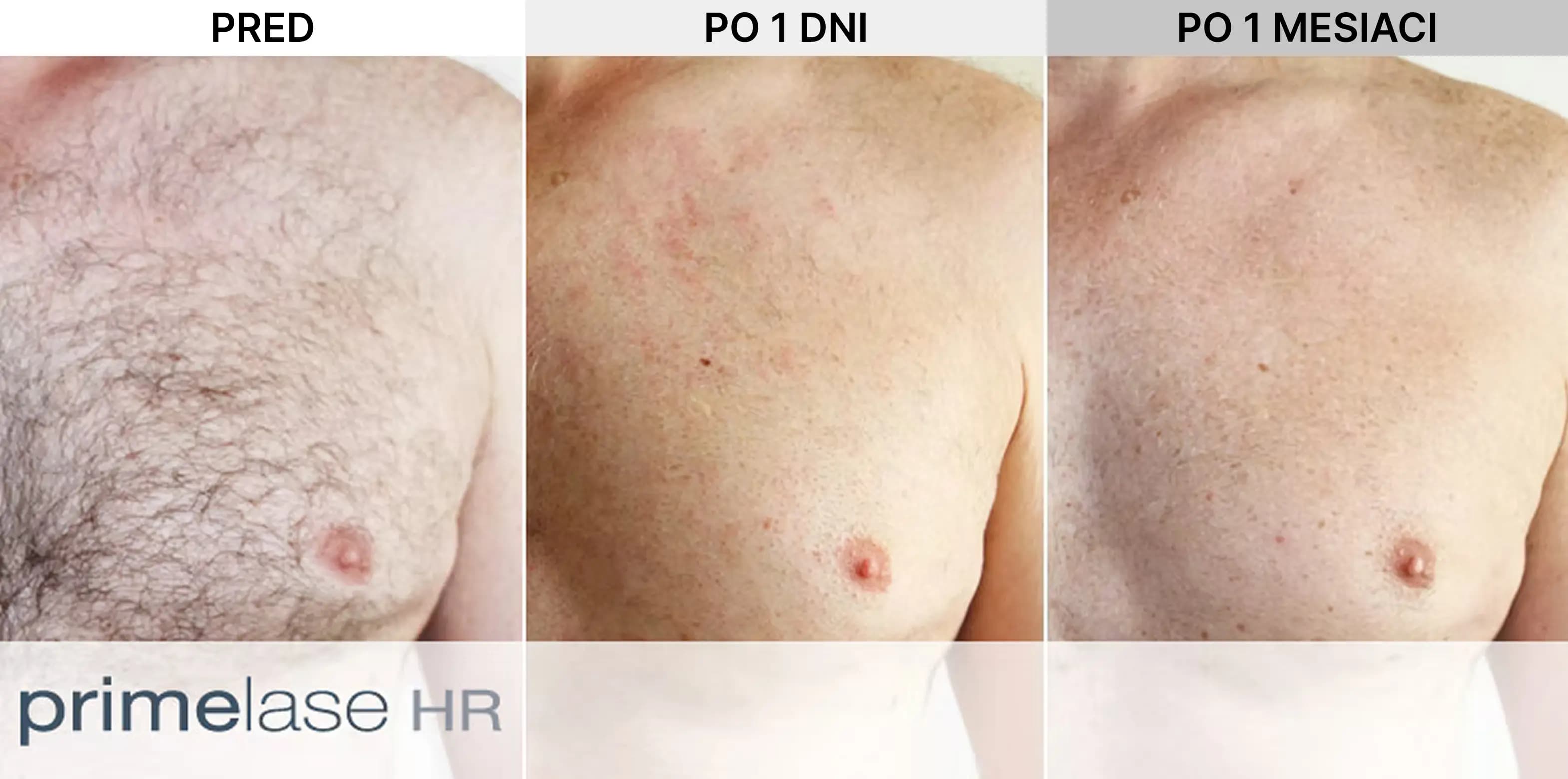 Laserová epilácia – Hrudník, výsledok pred a po